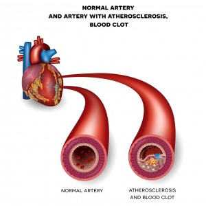 Carotid Artery Blockage