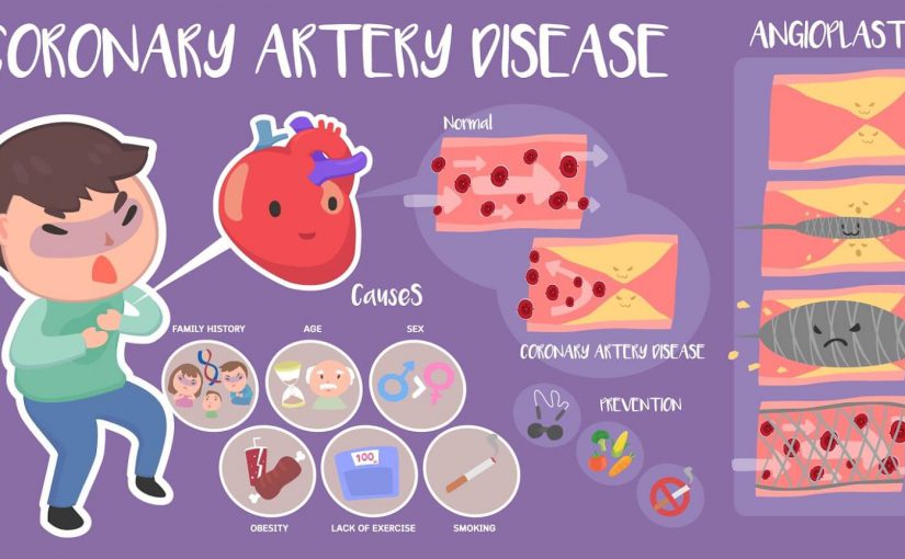 How Can a Person Know if Their Arteries Are Clogged? - Cardiac ...